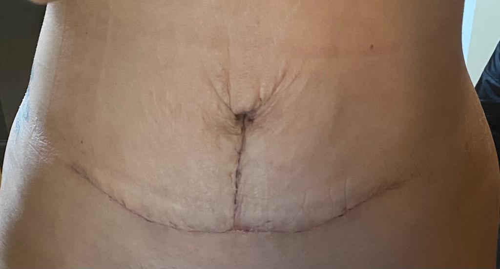 Laura's abdominoplasty tummy tuck (with pictures)